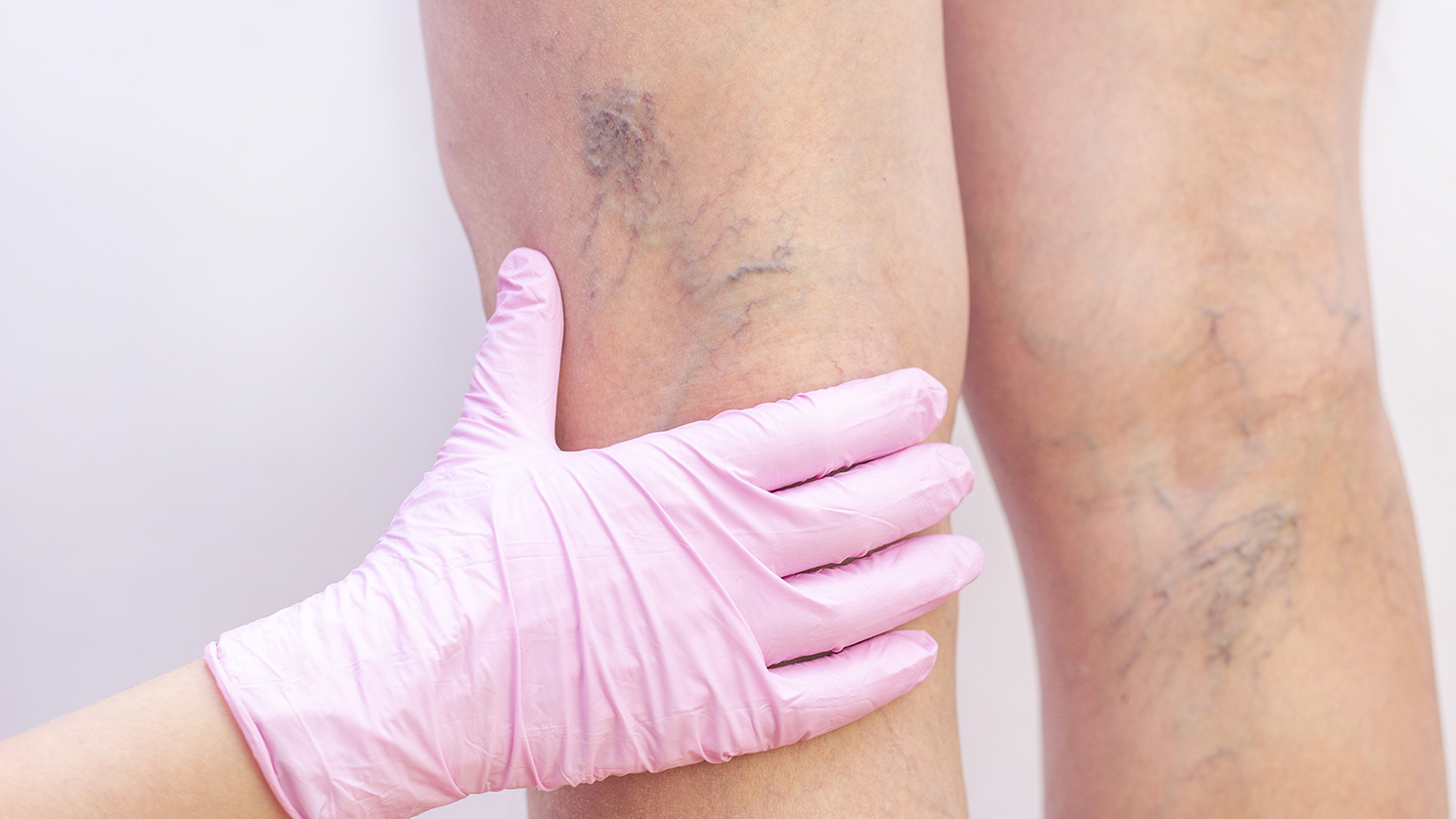 Addressing Peripheral Vascular Issues For Kidney Patients