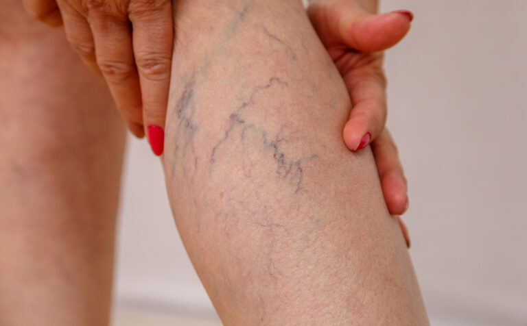 Older woman seeking Sclerotherapy treatment, holding her leg showing varicose and spider veins